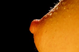 La presencia de un papiloma intraductal puede representar un riesgo de padecer cáncer.