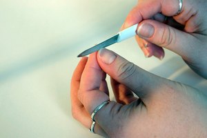 La coiloniquia puede ser un síntoma de anemia por deficiencia de hierro.