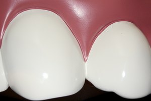 El blanqueamiento hace que los dientes estén nacarados y agradables.
