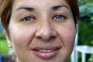La hidroquinona puede ayudar a desvanecer pecas y manchas marrones de la piel.
