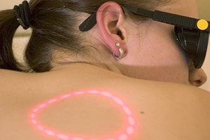 El tratamiento láser IPL es un procedimiento cosmético no quirúrgico para la piel.