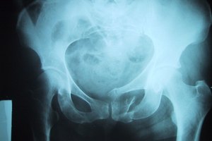 Los ejercicios Kegel fortalecen los músculos del suelo pélvico.