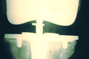 El tiempo que dura una prótesis de rodilla varía de una persona a otra.