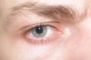 El ojo seco puede causar enrojecimiento e irritación.
