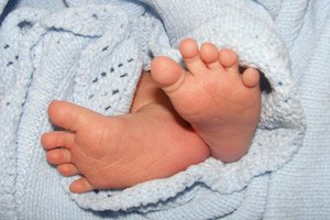 La ictericia es un trastorno común que afecta a los recién nacidos.