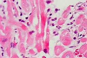 Los usuarios deThreelac pueden ser más propensos a sufrir infecciones del tracto urinario.