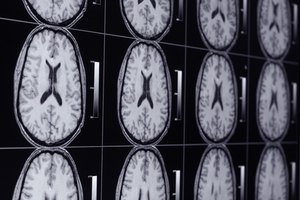 El cáncer de cerebro está dividido en cuatro etapas progresivas y superpuestas.