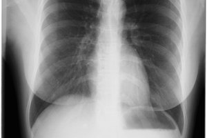 Tu quiropráctico puede recomendar una radiografía para ayudar a diagnosticar tu condición. La decisión de tomar las radiografías se debe basar en la necesidad médica.