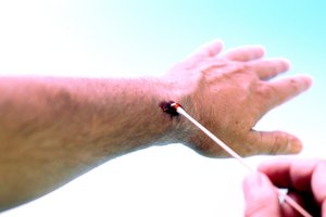 Se cree que la centella asiática acelera la cicatrización de las heridas.