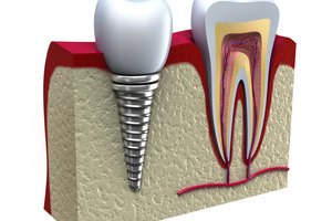 La pérdida ósea dental o la pérdida de hueso en los dientes se puede referir a la descomposición del tejido óseo en las raíces de los dientes y la mandíbula.