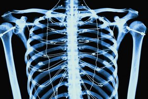 Hay varios tipos diferentes de quistes óseos y determinar qué tipo tienes exige un examen médico y pruebas diagnósticas.