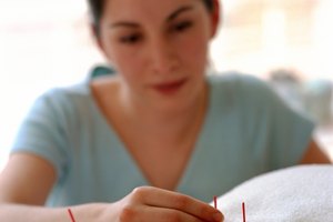 El tratamiento de acupuntura debe ser complementado con mejores hábitos.