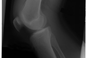 Limita el ejercicio de alto impacto si padeces el síndrome de la plica.