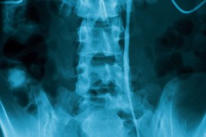 Restaura la salud de la espalda inferior a través de fortalecimiento de los músculos.