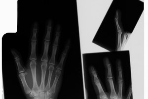 Los médicos utilizan férulas y yesos para el tratamiento de fracturas.