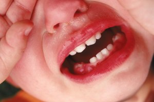 Los abscesos en los niños causan dolor severo.