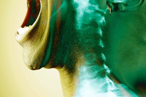 Un esguince en el cuello produce dolor.