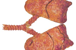 Una lobectomía es una opción de tratamiento para diversas enfermedades pulmonares.