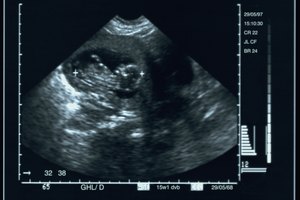 La edad fetal real es sólo una o dos semanas.