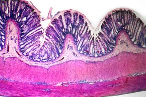 Las respuestas inapropiadas de los linfocitos intestinales pueden conducir a trastornos inflamatorios, tanto en el intestino delgado como en el grueso.