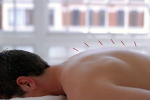 La acupuntura puede aliviar el dolor de articulaciones.