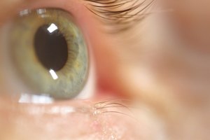La rosácea ocular suele estar caracterizada por enrojecimiento e irritación.