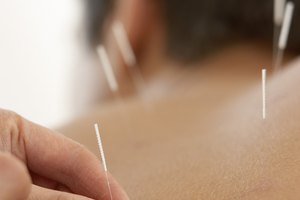 La acupuntura puede ayudar en muchas condiciones médicas como la del quiste de Baker.