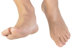 Las grietas en los pies, no necesariamente son resultado de la piel seca.