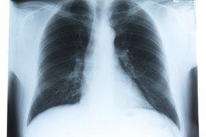 Una lesión en los pulmones necesita ser tratada rápidamente.