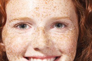 Las pecas pueden ser tan pequeñas como de un centímetro de diámetro.