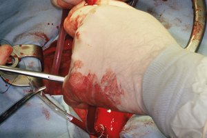 La endocarditis aparece con mayor frecuencia en las personas con una enfermedad cardíaca existente que se someten a una cirugía cardíaca o dental.