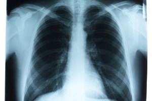 Las placas de rayos X del pecho revelarán las causas del crujido de tus pulmones.