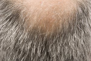 El ciruelo africano no ha sido clinicamente probado como una ayuda en la prevención de la caída de cabello.