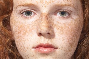 Algunas cremas que contienen hidroquinona, ácido glicólico, desoxiarbutina e hidroquinona pueden desaparecer manchas oscuras por daño solar.