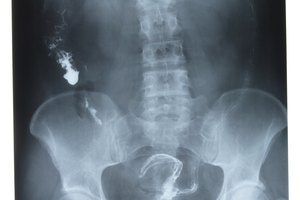 Las radiografías de las caderas y pelvis se utilizan para diagnosticar fracturas por estrés y artritis.