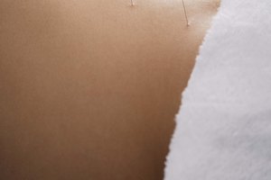 La acupuntura puede aliviar el dolor en las espinillas.