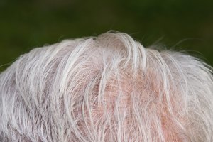Alopecia.