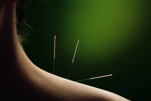 Acupuntura.