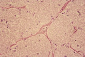 La neuropatía periférica es una condición incómoda y usualmente dolorosa.