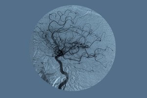 Se utilizan unos rayos x especiales para buscar algún bloqueo en las arterias del cuello.