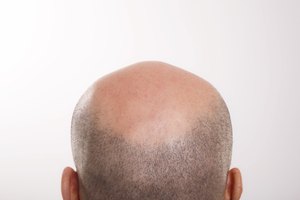 La caída del cabello puede ser hereditaria.