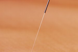 La acupuntura trata las hemorroides con eficacia.