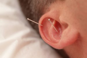 La auriculoterapia se emplea para el tratamiento de hemorroides.