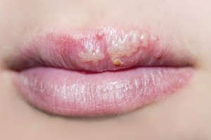 Herpes simple en la boca.