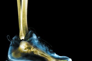 Las cámaras de aire sin la amortiguación correcta puede resultar en lesiones de tus ejercicios como por ejemplo el síndrome de banda iliotibial y fasciitis de planta.
