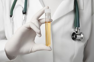 Las enfermedades de almacenamiento de lípidos se pueden detectar con pruebas de orina.
