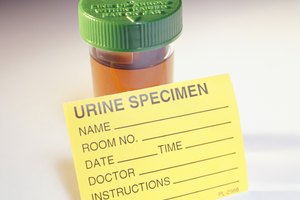 La sangre en la orina de una persona con lupus puede indicar una inflamación en los riñones.