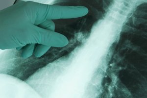Es una enfermedad que se caracteriza por los espacios anormales y amplios de aire en los pulmones.