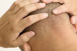 El cabello ralo en los hombres se presenta cuando el diámetro del folículo del pelo comienza a encogerse.