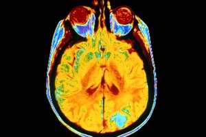 Los tumores cerebrales por lo general se ven en una PET (tomografía por emisión de positrones).